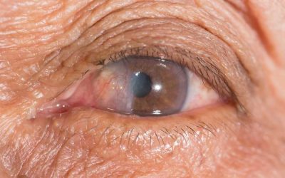 Pterygium Treatment and Causes
