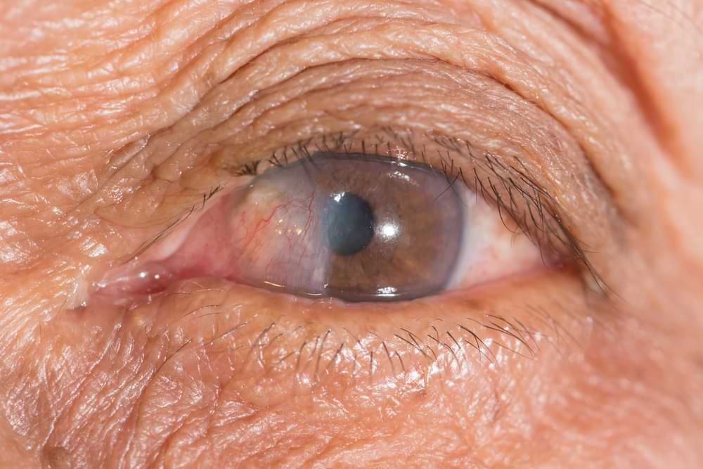 Pterygium Treatment and Causes