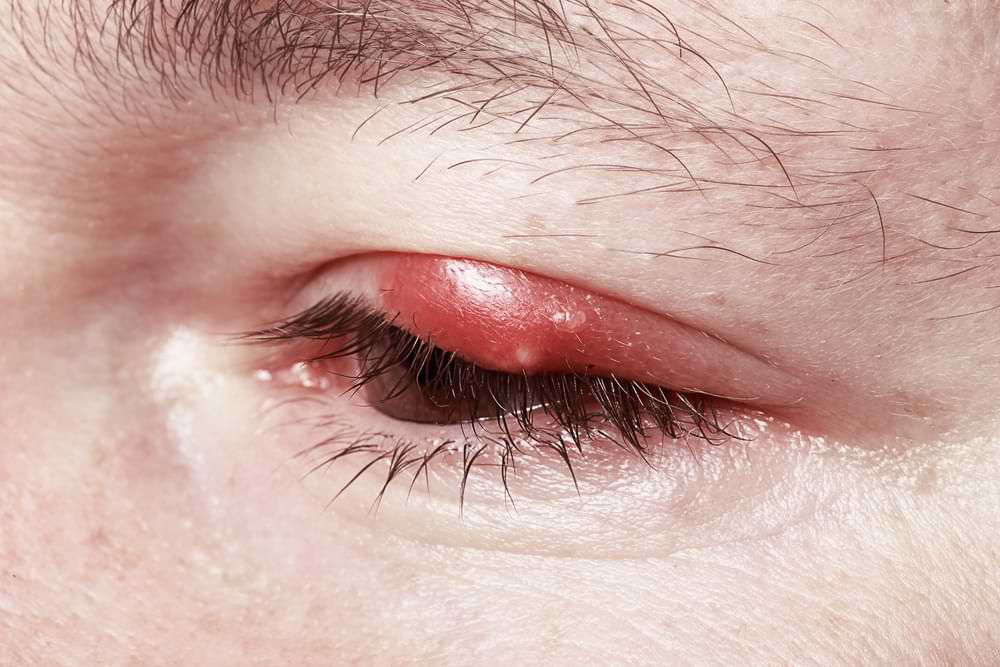 eye infection